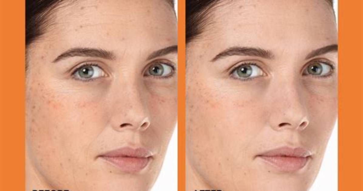 Before and After at the C Spot La Dermatologist Insights And