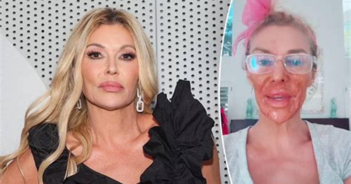 Brandi Glanville Nair Burn Incident Timeline of the Reality Star S Viral