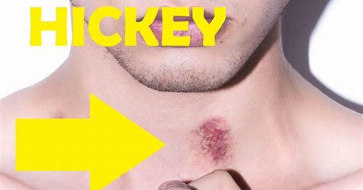 Can a Hickey Actually Cause Serious Medical Harm Separating Myths From