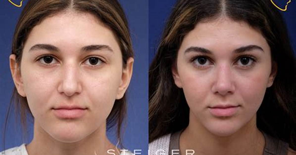 Clavicular Nose Job Before and After the Dr Miami Reveal