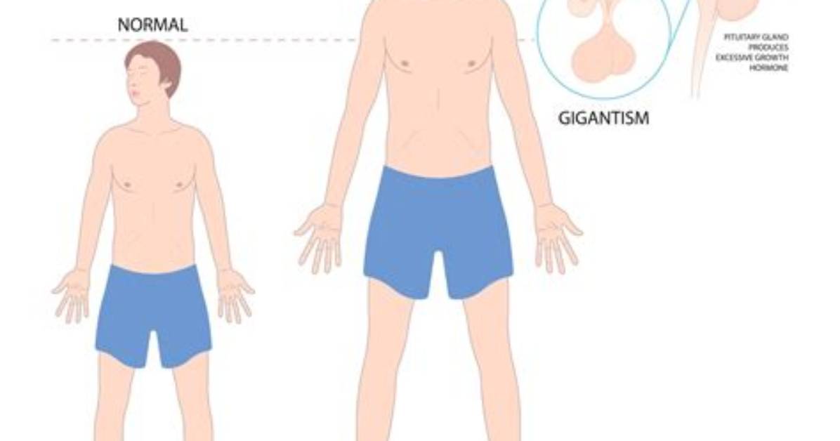 Clinical Signs of Gigantism Why Doctors Now Treat It as A