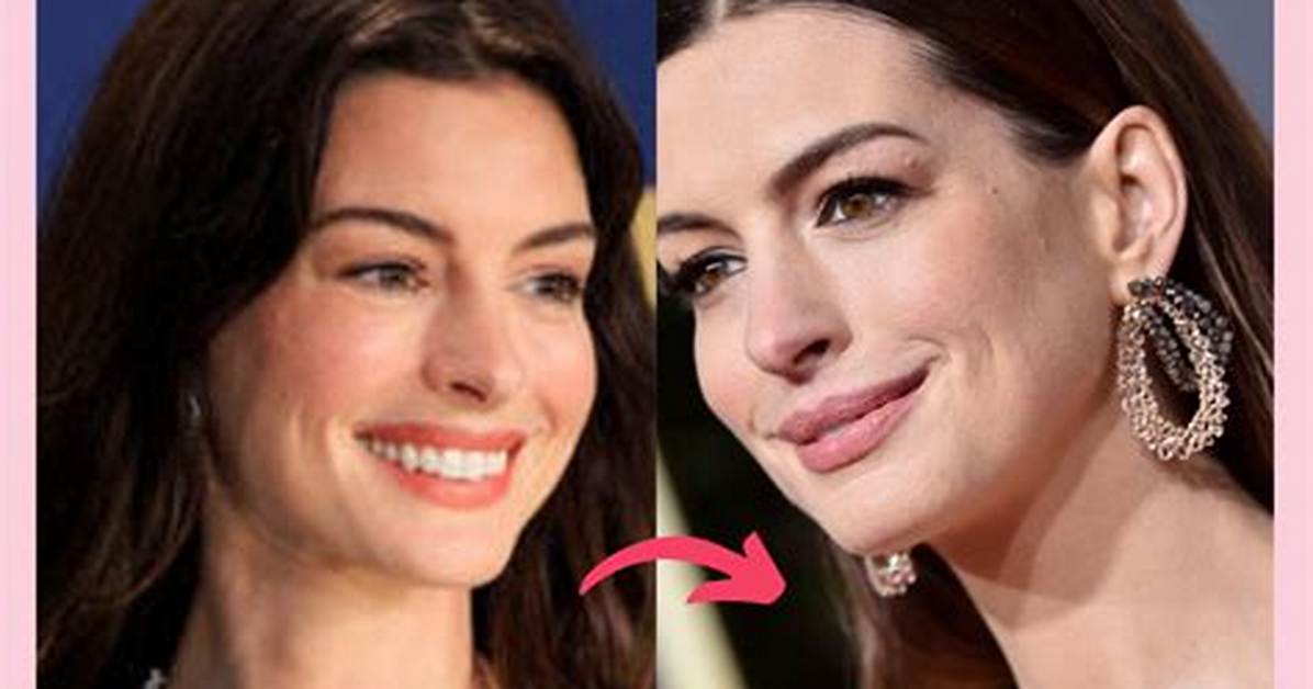 Did Anne Hathaway Get Botox the Star Breaks Her Silence on Distracting