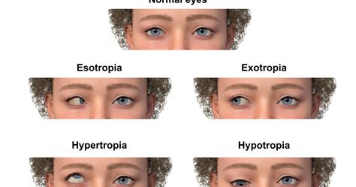 High Profile Strabismus Cases Spark Surge in Corrective Eye