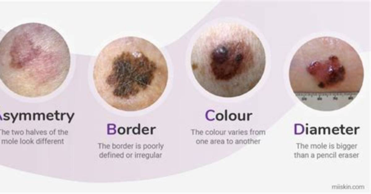Mole or Melanoma Visual Signs Ai Diagnostic Apps Miss Across Diverse