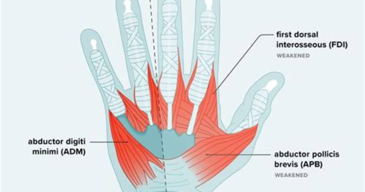 New Clinical Warnings on Hand Weakness When Slipping Grip Signals Serious