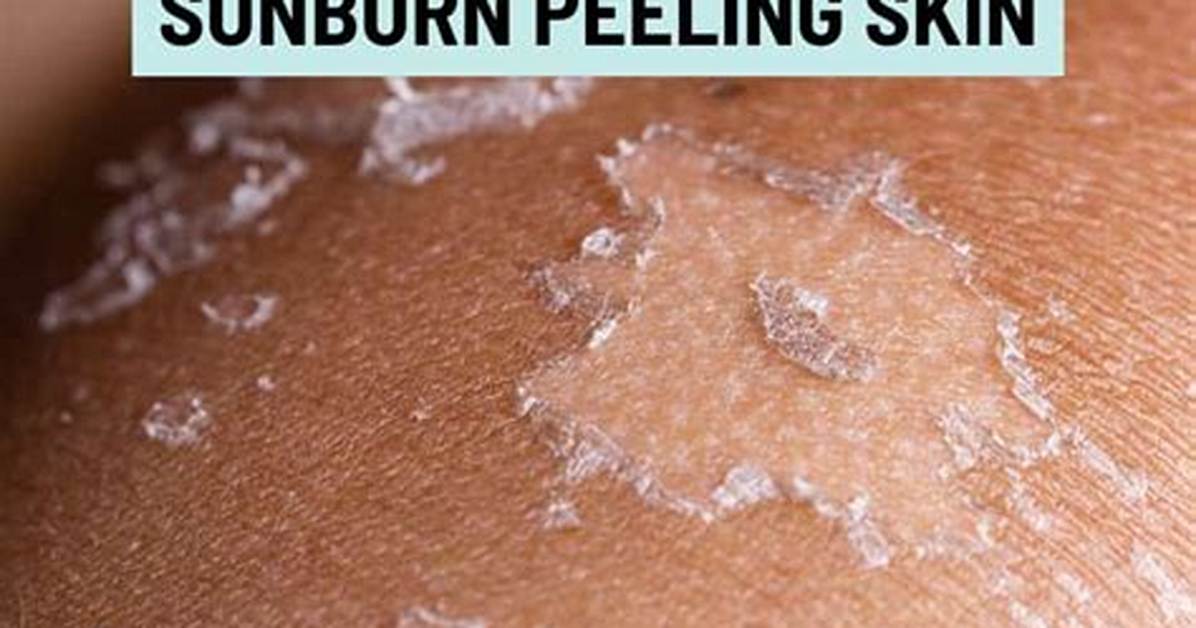 Should You Peel Shedding Sunburn Skin Dermatologists Debunk The